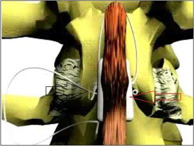 Abbildung 21: Interspinöse Lage des DIAM-Implantates von dorsal.