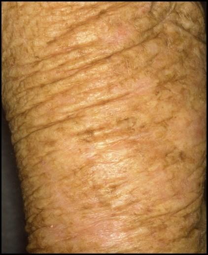 Klinisch und morphologisch werden mittlerweile zwei Formen der extrinsischen Hautalterung unterschieden, die atrophische Form der Lichtalterung und die Form der Milians zitrinen Haut.