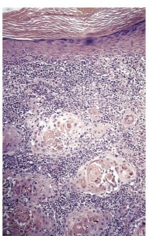 Abb. 22: Histologisches Bild eines Plattenepithelkarzinomes [10] Außerdem sollte eine Inspektion der gesamten Haut der Betroffenen erfolgen, da SCC häufig multipel oder in Kombination mit Basaliomen