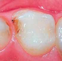 dar (Abb. 5). Oftmals sind betroffene Zähne insbesondere bei Kälte und Hitze sehr empfindlich, was die Lebensqualität einschränken kann.