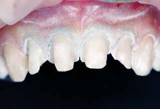 Abb. 7: Leichtes Bestäuben der präparierten Zähne mit 3M High-Resolution Scanning Spray, einer Mischung aus Titan- und Zirkoniumoxidpulver und Zinkdistearat zur Vorbereitung der intraoralen