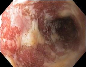 Crohn und Colitis ulcerosa PD Dr. med.