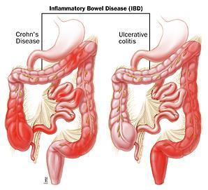 Einführung Morbus Crohn (CD) und Colitis ulcerosa (UC) befallen Patienten v.a. während der reproduktiven Phase Hohe Prävalenz in Europa: 1/1000 CD befällt etwas mehr Frauen (sex ratio 1.