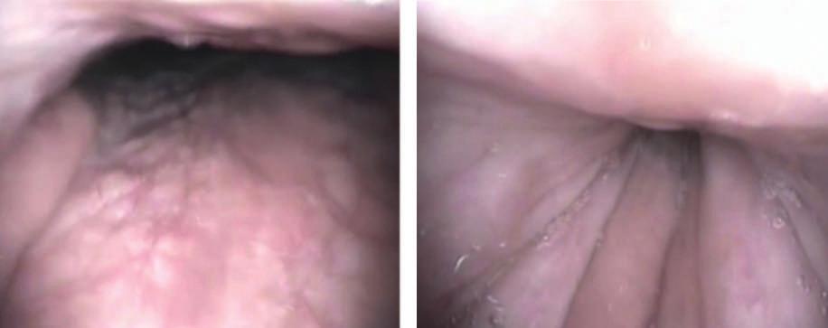 ÜBERSICHTSARTIKEL 276 Abbildung 1: Beispiel eines konzentrischen velaren Verschlusses. Sicht vom Nasenrachen auf den Mesopharynx.