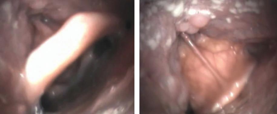 Im zweiten Bild bewegen sich die Tonsillen und Pharynxseitenwände ( ) gegen die Mitte, die durch die Epiglottis markiert wird ( ).
