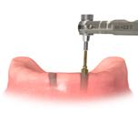 Achtung In den USA ist der Verkauf nur an einen lizenzierten Mediziner oder Zahnarzt erlaubt. Sterilisation Alle Komponenten und Instrumente werden NICHT STERIL geliefert.