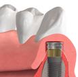 Edelstahlgehäuse geben. Positionieren Sie die Prothese im Mund und lassen Sie den Patienten den Mund mit leichten zentrischen Okklusionskontakten schließen.