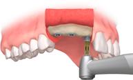 Insertion des Neoss Implantates maschinell Nach sorgfältiger Präparation des Implantatbettes wird das Implantat wie folgt inseriert: 1.