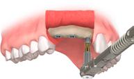 Insertion des Neoss Implantates manuell Nach sorgfältiger Präparation des Implantatbettes wird das Implantat wie folgt inseriert: 1.