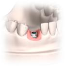 3:28 Neoss Implantat System zahntechnische Richtlinien 7. Überprüfen Sie das Abutment im Mund des Patienten. Anschließend ziehen Sie die Abutmentschraube mit maximal 32 Ncm an.