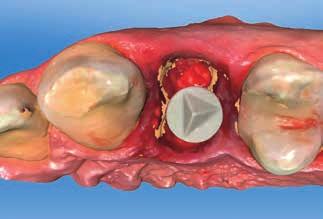 Der digitale Andruck dient somit als GingivaVorlage. Nach der Wurzelextraktion wird das Implantat eingesetzt (Xive S, Dentsply).