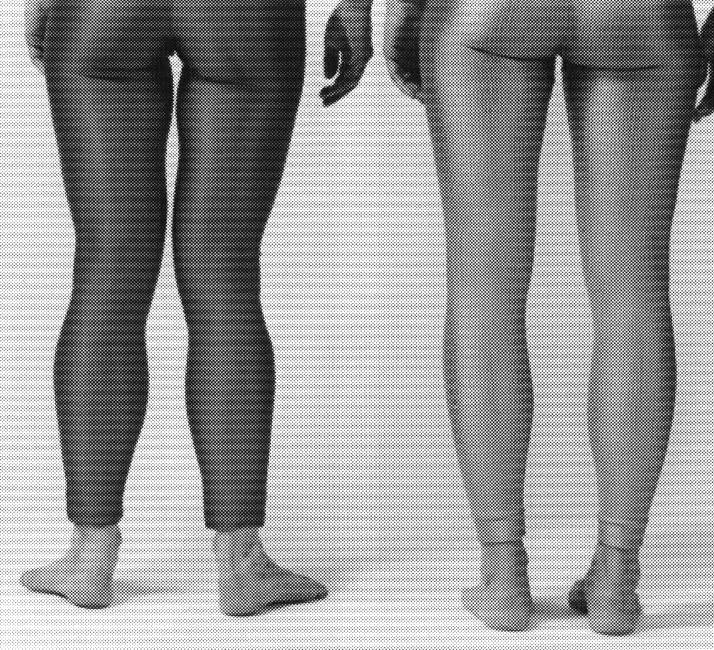 Beine Füsse: Innenrotierte Oberschenkel, Abweichung von der parallelen Fussstellung mit Tendenz zu Knickfüssen, bewirken einen Verlust der spiraligen Verschraubung des Beines.