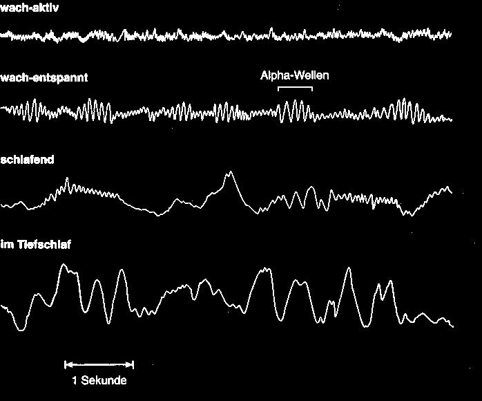 Beispiele für typische EEG-Muster bei