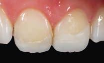 Abb. 2a und b Simulation des zu erwartenden Ergebnisses mit einem Mock-up: Die Zähne wurden in Länge sowie