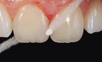 Die neutral modulierende Schmelzmasse TN auf dem Dentin sollte der Restauration Tiefe und Leben geben.