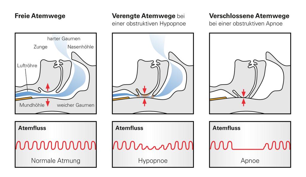 Kardiorespiratorische Polysomnographie EEG EOG EMG Hypersomnien zentralen Ursprungs Bsp: Narkolepsie mit Sleep Onset REM Kardiorespiratorische Polysomnographie EEG EOG EMG
