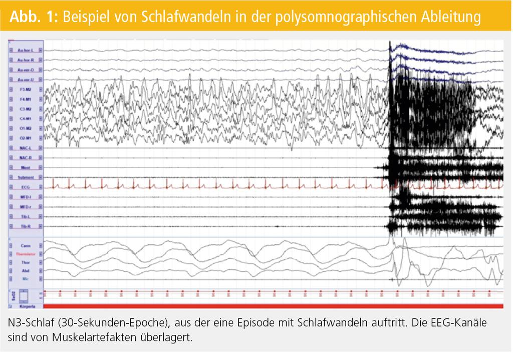 Kardiorespiratorische Polysomnographie EEG EOG EMG Atmung EKG oronasal thorakal abdominal