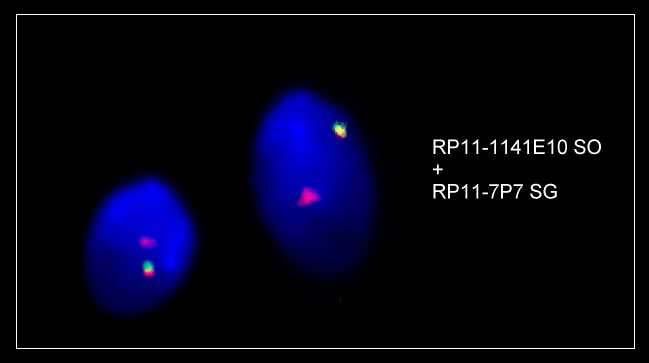 3 Ergebnisse 79 Abb. 21: Darstellung der BAC-Signale in Spermien. Die BACs RP11-1141E10 (markiert in SO) und RP11-7P7 (markiert in SG) zeigen beide ein Signal auf Chromosom 7.