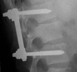 Es besteht aus Pedikelschrauben verschiedenen Durchmessers (4 8 mm) sowie verschiedener Längen unter Berücksichtigung des unterschiedlichen anatomischen Aufbaus der Wirbel in verschiedenen