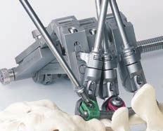 The connector will be adjusted to the cone of the pedicle screw. Turning the pedicle screw with the T-wrench (CS 2840-2) adjusts the head of the screw cone to the opening at the connector.