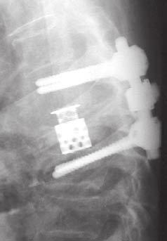 Flexion/Extension after implant removal Spinal Injuries