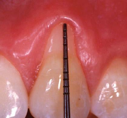 Porcin Straumann Emdogain Schmelz-Matrix-Proteine Emdogain für die Regeneration der oralen Hart- und Weichgewebe Parodontitis ist mit einem irreversiblen Verlust der Gewebe des Zahnhalteapparats