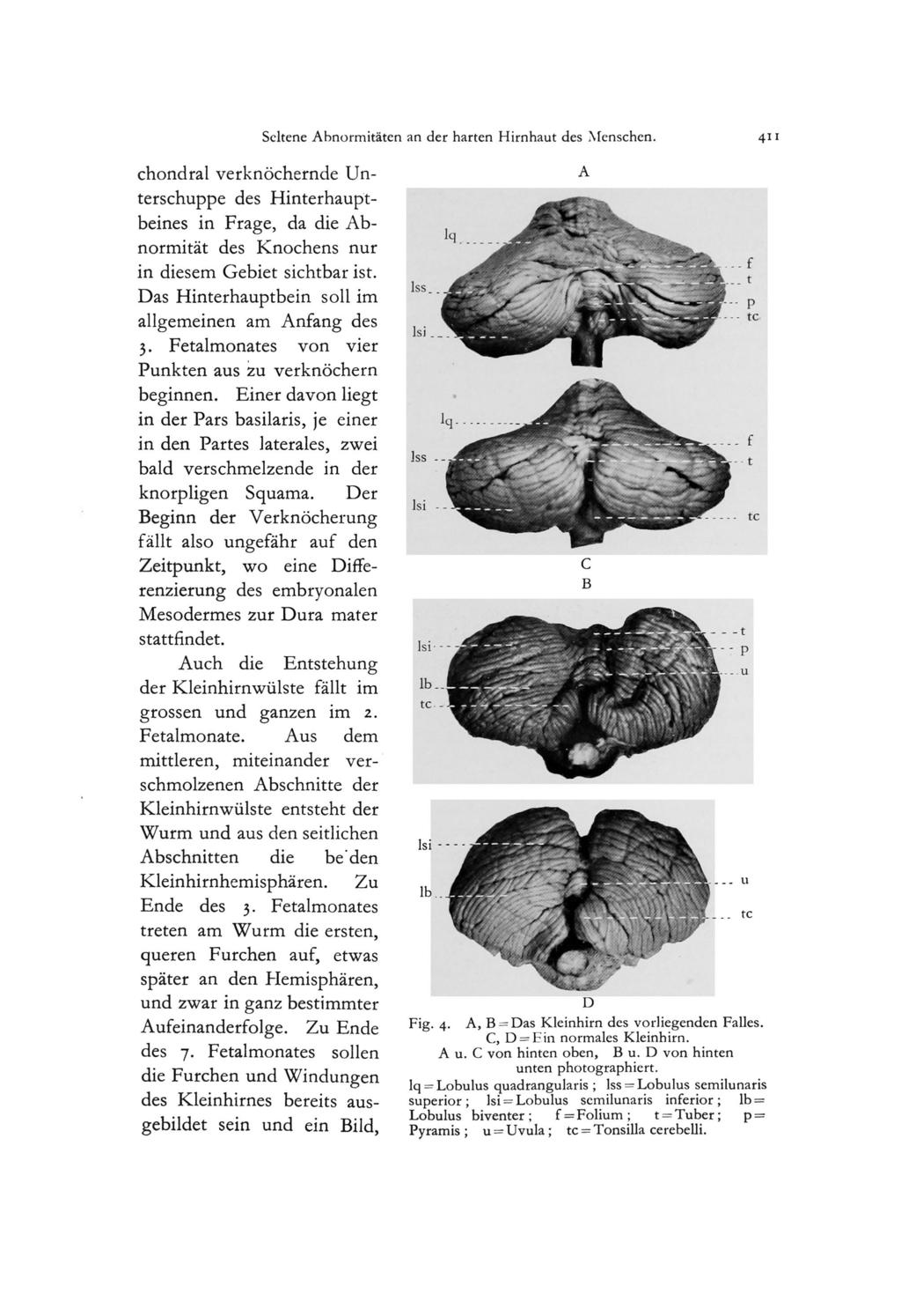 Seltene Abnormitaten an der harten Hirnhaut des Menschen. 411 chondral verknochernde Unterschuppe des Hinterhauptbeines in Frage, da die Abnormitat des Knochens nur in diesem Gebiet sichtbar ist.