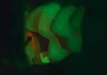 Die fluoreszenzgestützte Identifizierung des kariösen Gewebes ist unter dem Mikroskop durch einen einfachen