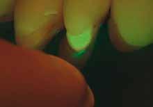 Der Fluorescence von ZEISS EXTARO 300 hilft Ihnen, Schmelz und Dentin des Zahns von den