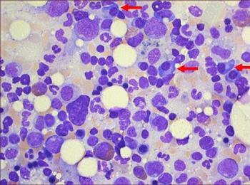 2 Verlauf Das Risiko für den Übergang von einer MGUS in ein Multiples Myelom liegt bei 1 1,5 % pro Jahr. Allerdings ist das Risiko nicht für alle Betroffenen gleich hoch.