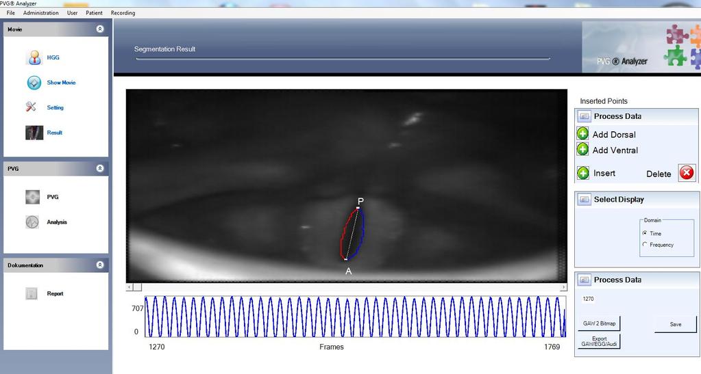 Abbildung 7: Segmentierung der Stimmlippenschwingungen an Hochgeschwindigkeitsaufnahmen des Kehlkopfes während der Phonation 2.