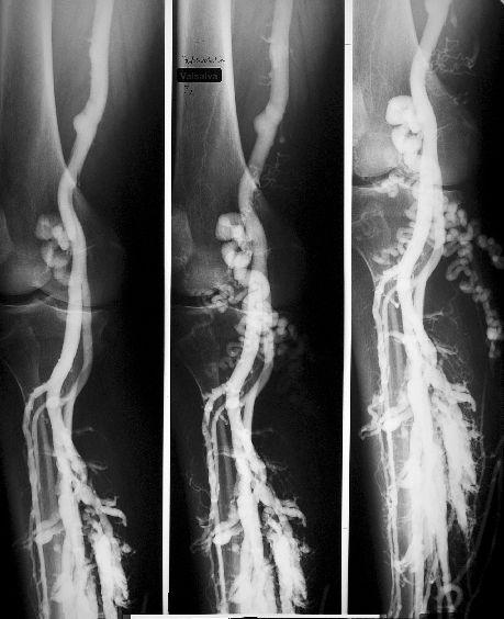 ) Pressphlebographie: Aus ihrem Mündungstrichter, 5 cm oberhalb des Kniegelenkspalts, füllt sich im Reflux eine