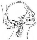 Airway management in the patient with potencial cervical spine