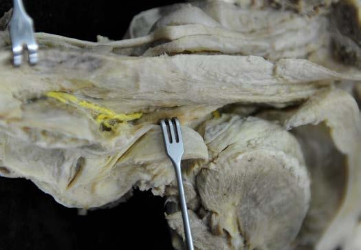Pharynx und Larynx tief: Durchtritt des Ramus internus des N.