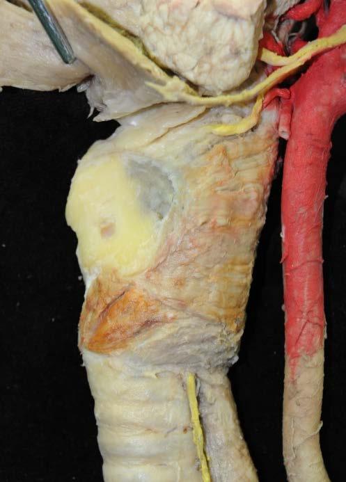 Larynx tief: M. cricothyroideus () und Lig. cricothyroideum medianum (Lig.