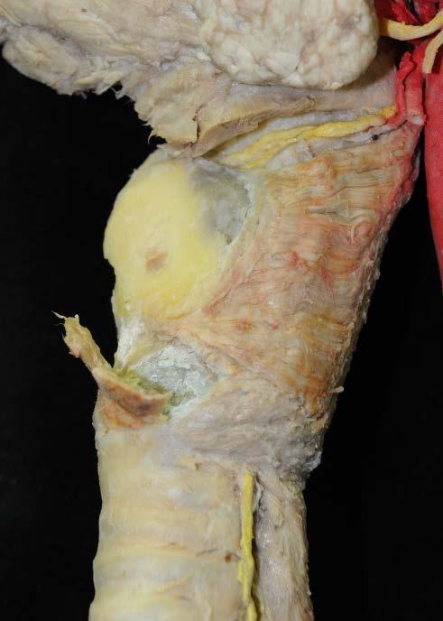 cricothyroideus () am Schildknorpel ablösen (Markierung) und wegklappen.