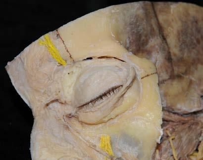 orbicularis oculi () scharf begrenzen und vom darunterliegenden Lig. palpebrale laterale und vom Septum orbitale abtrennen und nach medial klappen.