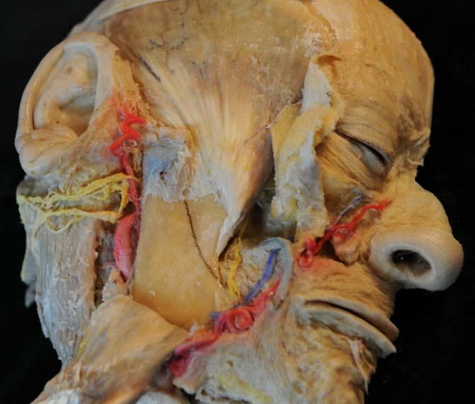 Dabei wird der Muskel scharf vom Ramus mandibulae () abgelöst und bleibt am Angulus mandibulae hängen. tief: Den N.