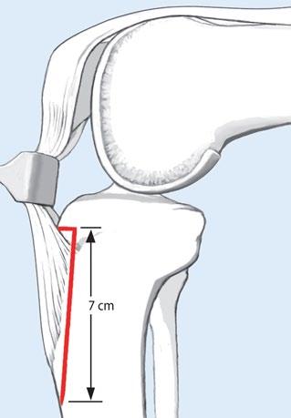 Abb. 1 8 Proximal stufenförmige, distal flach auslaufende Osteotomie (rot): Die horizontale Osteotomie befindet sich unmittelbar proximal des Ansatzes des Lig. patellae.