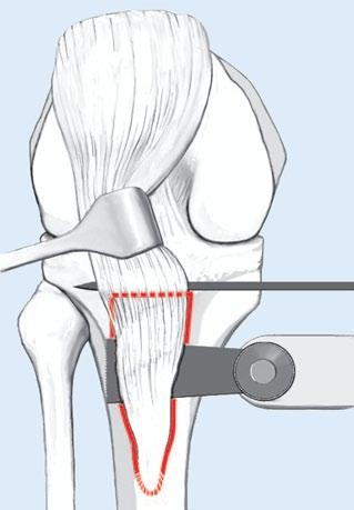 2 8 Reihenfolge und Durchführung der Osteotomien: Zuerst erfolgt das Anlegen der Stufe mit einem 7 mm breiten Lambotte-Meißel, danach die frontale Osteotomie mit der oszillierenden Säge oder mit der