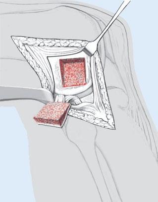 Abb. 4 8 Kastenförmige Osteotomie des Epicondylus femoris lateralis mitsamt den Ansätzen von Lig. collaterale laterale und Sehne des M.