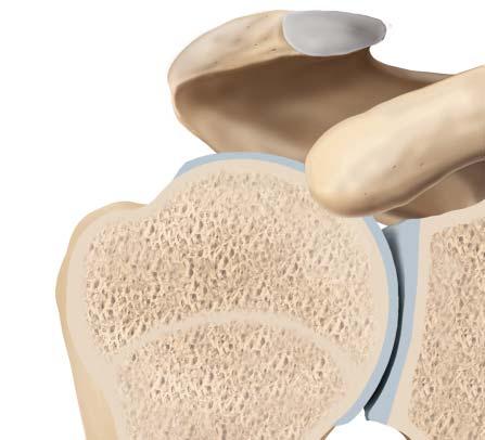 2.1 Einleitung Akromion Cavitas glenoidalis Gelenkknorpel des Humeruskopfes Labrum glenoidale Abb. 2.4 Glenohumerale Gelenkflächenkongruenz (nach Omer Matthijs). Außenrotation.