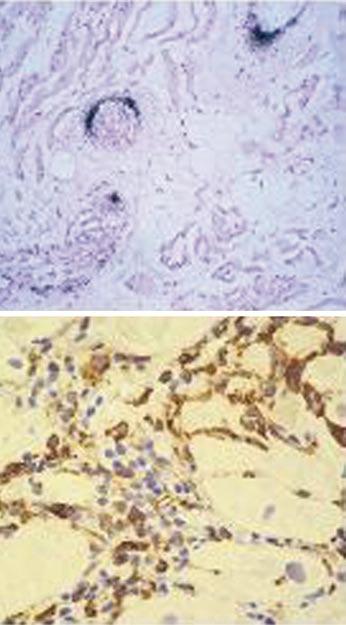 3 7 Akute B19-assoziierte inflammatorische Kardiomyopathie mit dem Insitu-Hybridisierungsnachweis viraler Genome in