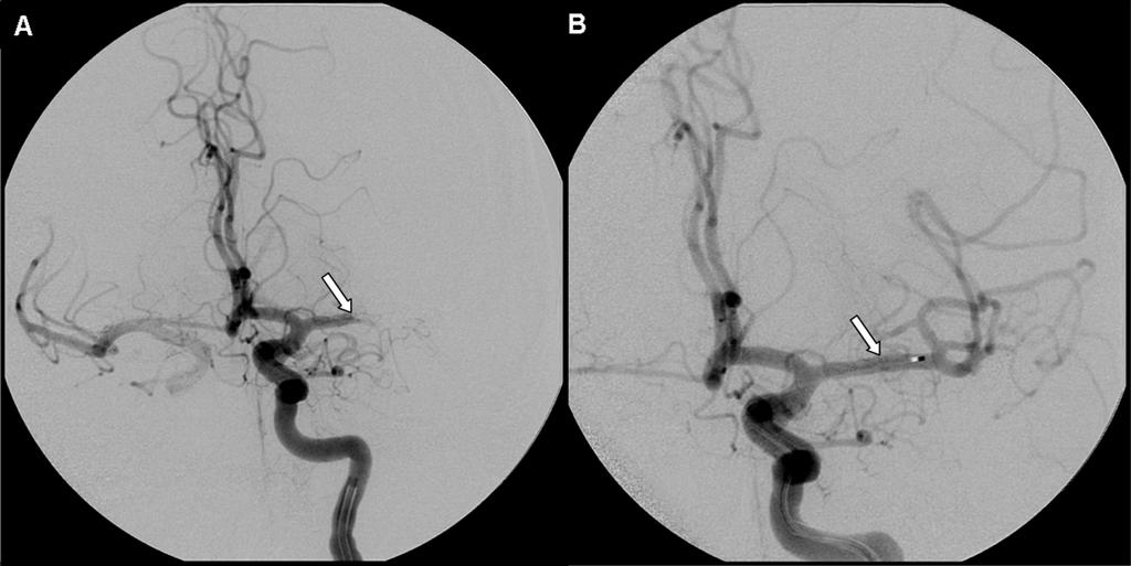Ergebnisse 29 Abbildung 7: Angiographischer Verlaufsbefund eines erfolgreich rekanalisierten M1-Verschlusses 67-jähriger Patient mit Verschluss des distalen M1-Segments links (A; weißer Pfeil).