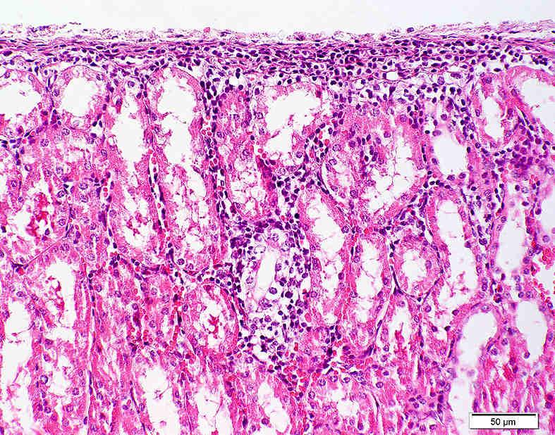 31: fokale interstitielle Nephritis: Zentrum einer lymphfollikelähnlichen Struktur mit Resten eines alterierten