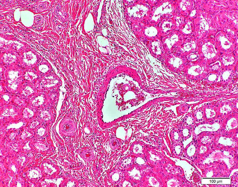 9 ANHANG 163 Nieren mit der makroskopischen Diagnose einer roten infarktähnlichen Läsion N T # G L Abb. 9.