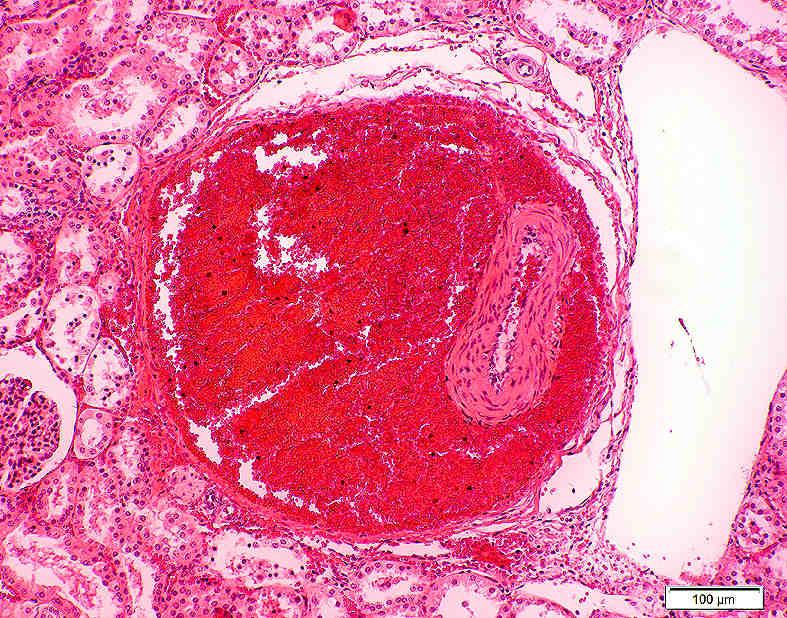 der Basis einer makroskopisch sichtbaren, roten infarktähnlichen Läsion; Nierentubuli (T); Nierenkörperchen (N); Lymphgefäß (L) H.-E.