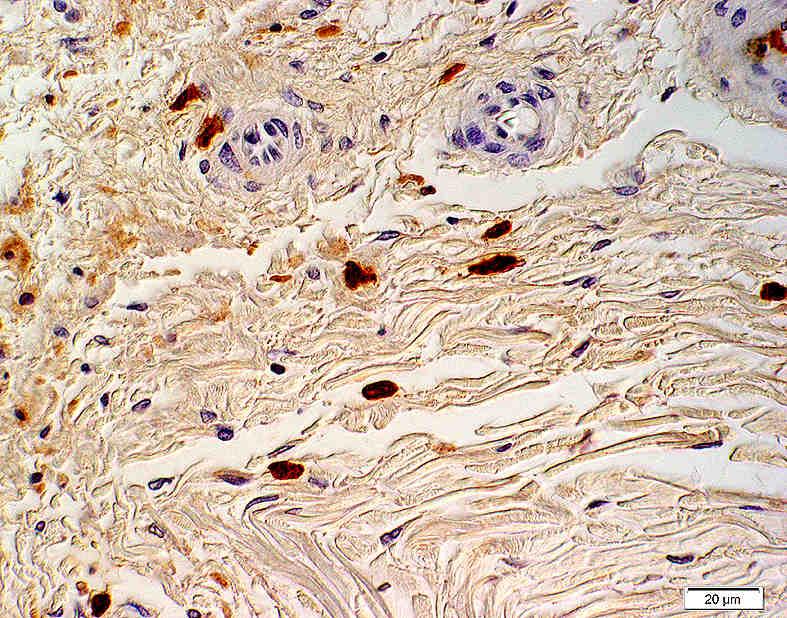 67: Laminin-Expression innerhalb eines roten Herdes der Nierenrinde: Nachweis einer schmalen subendothelialen Laminin- Expression ( ) der Basalmembran eines arteriellen Gefäßes innerhalb