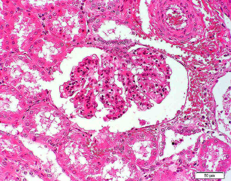 78: Glomerulum mit geringgradig vermehrtem Zellgehalt: geringgradig vermehrter glomerulärer Zellgehalt im Nierenkörperchen (N);