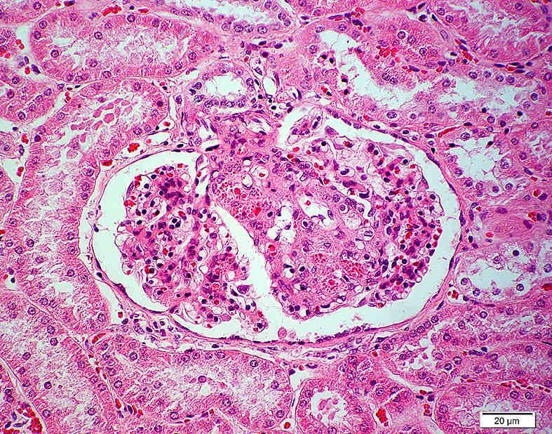 79: Glomerulum mit geringgradig vermehrtem Zellgehalt sowie verbreitertem Mesangium: geringgradig vermehrter glomerulärer Zellgehalt